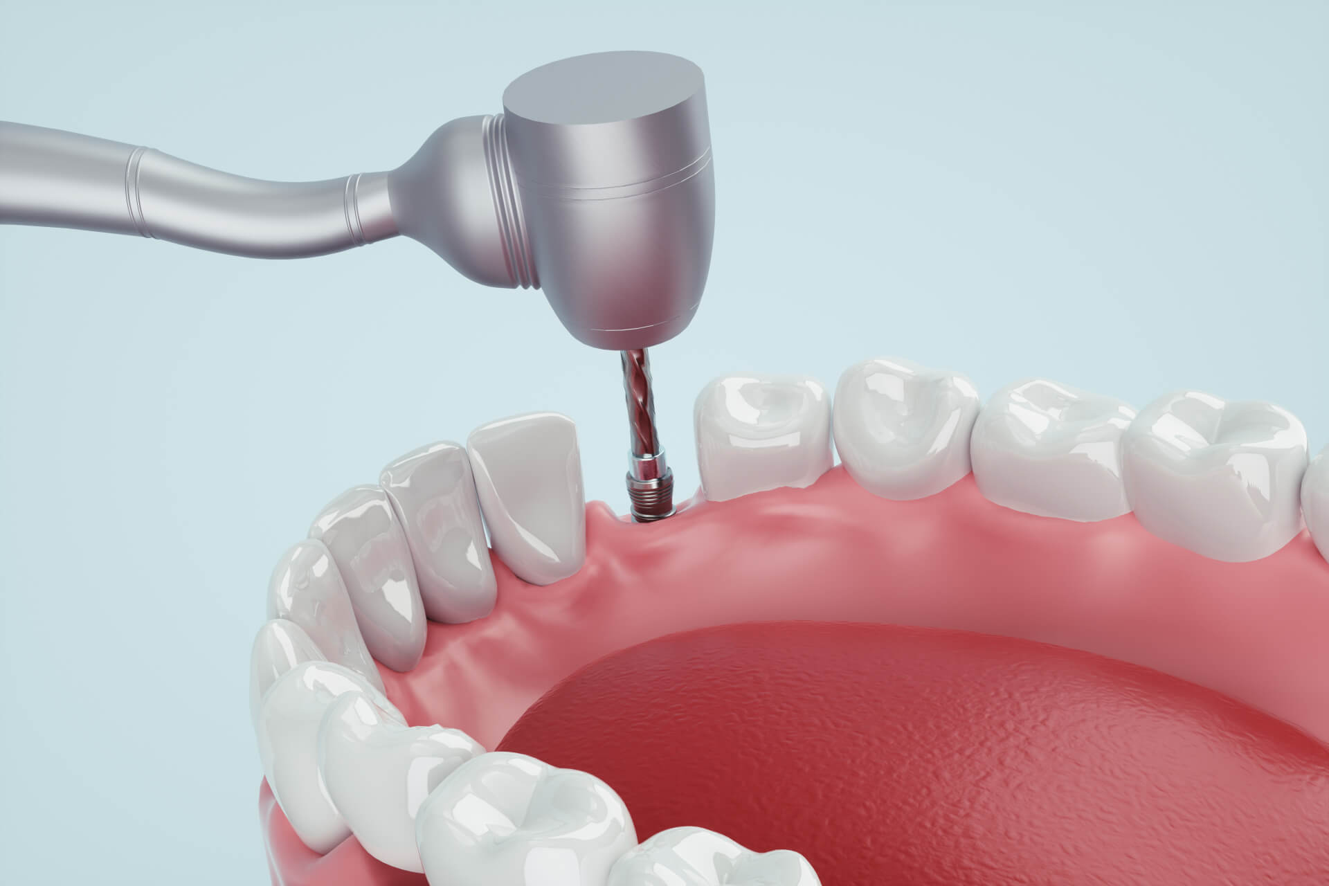 インプラント治療で抱えがちな不安