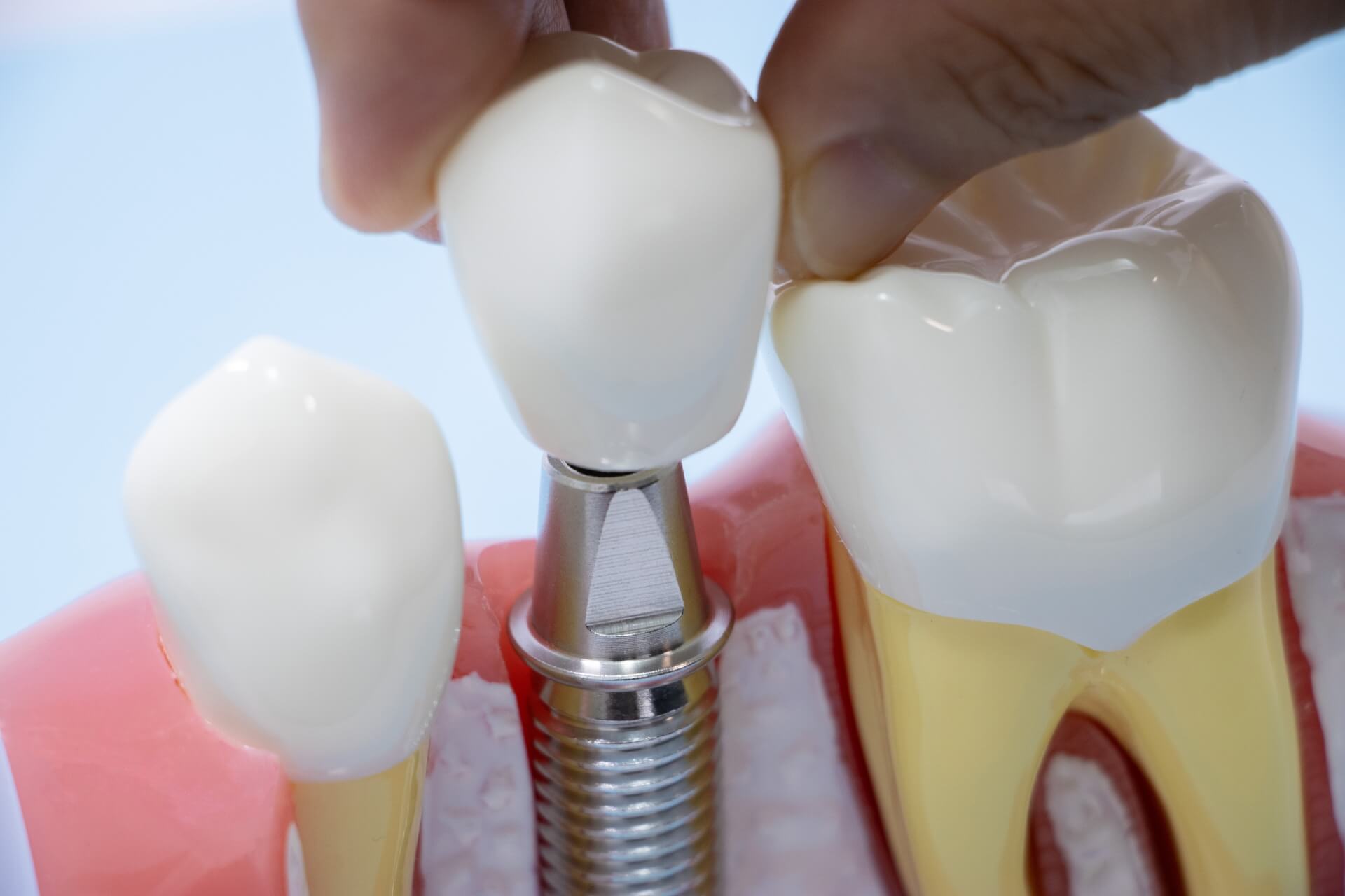 インプラント治療前に確認したいこと